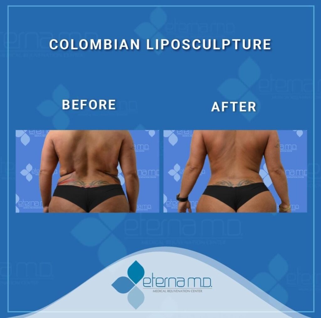 Colombian Liposculpture