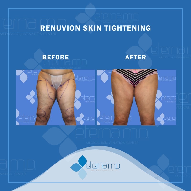 renuvion